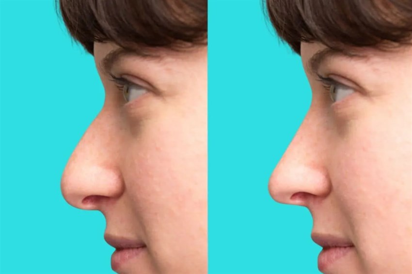 تفاوت رینوپلاستی با سپتورینوپلاستی؟ تحلیل پزشکی و عملکردی بینی